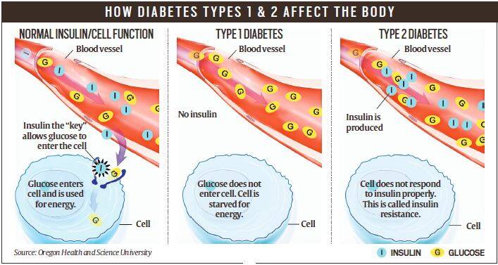 Type-1 Diabetes