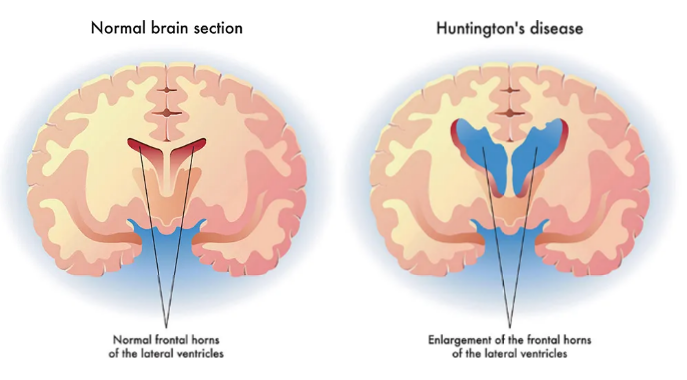 Hungtingstons disease