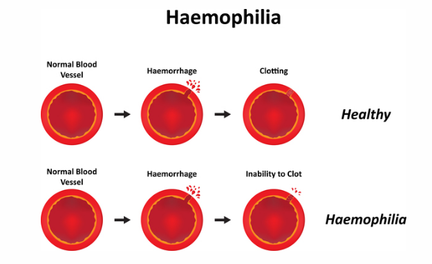 Haemophilia A