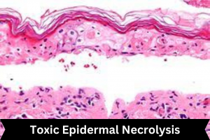 Toxic Epidermal Necrolysis